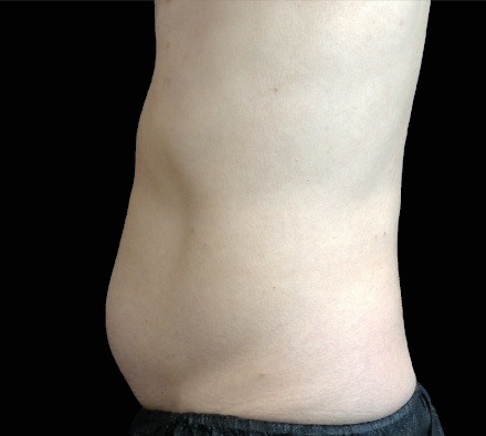 Male abdomen before and after EmSculpt Neo. Photos courtesy of David Kent, M.D.