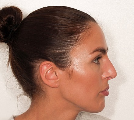 Before and After Non-surgical Rhinoplasty 