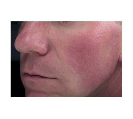 Rosacea treated with harmony vascular laser 