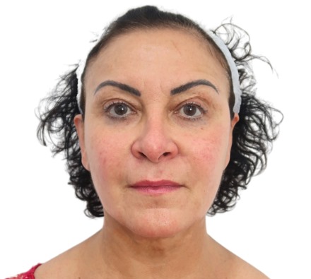 Before and after thread lift 