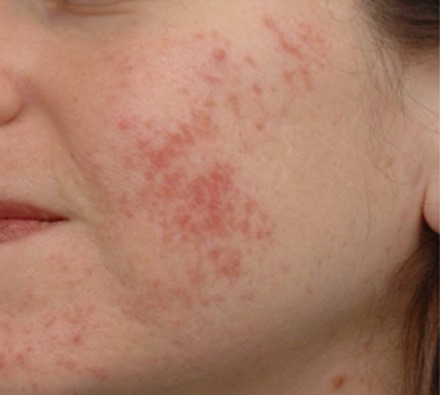 i-pixel harmony laser to treat acne scarring 