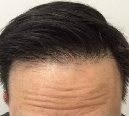 PRP Hair Loss Treatment Before and After