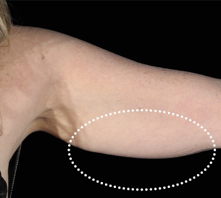Female arm before and after Emsculpt Neo. Photos courtesy of Robert Weiss, M.D.
