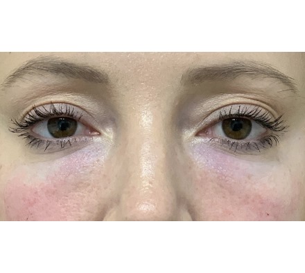 PRP Facial For Under Eyes Before and After Course of 3