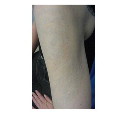 Arm (8 Treatments)