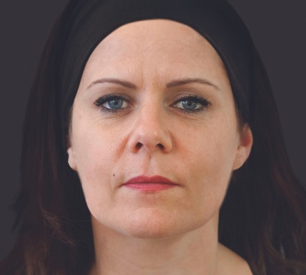 Here are some examples of the results we're able to achieve with Ellansé dermal filler...