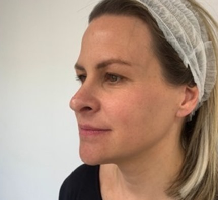 Before and after thread lift