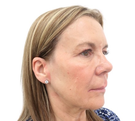 Before and after thread lift