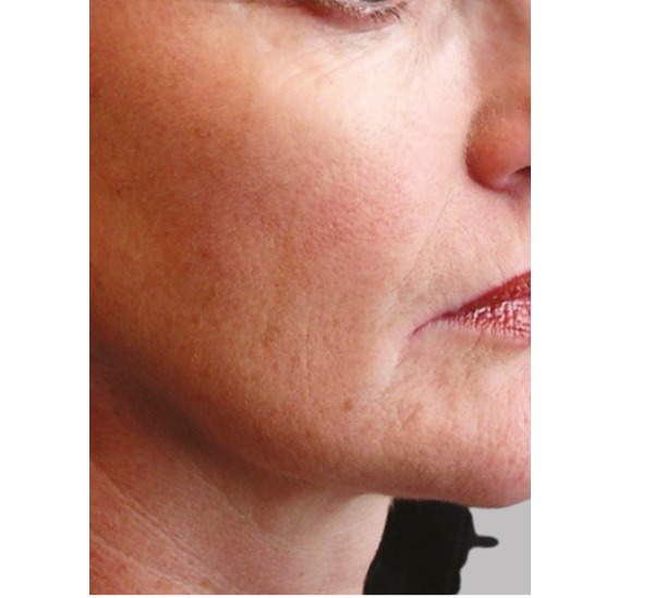 Before and After PRP Facial Therapy
