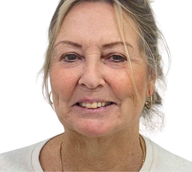 Quantum RF before and 10 weeks after treatment