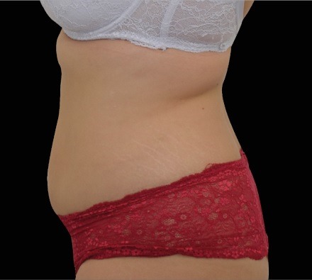 Female abdomen before and after EmSculpt Neo. Photos courtesy of BTL Aesthetics.