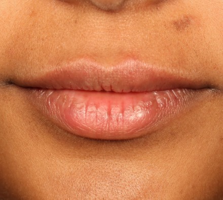 Lip filler before and after (1ml)