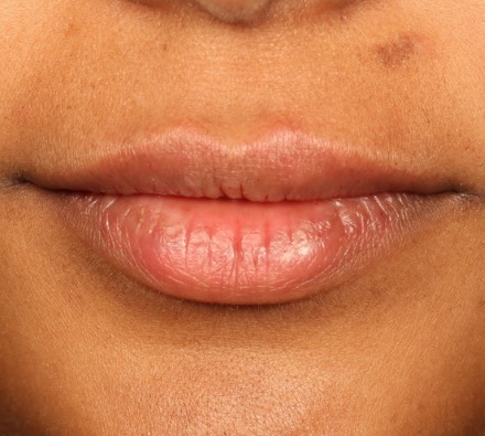 Lip Filler Before and After 1ml