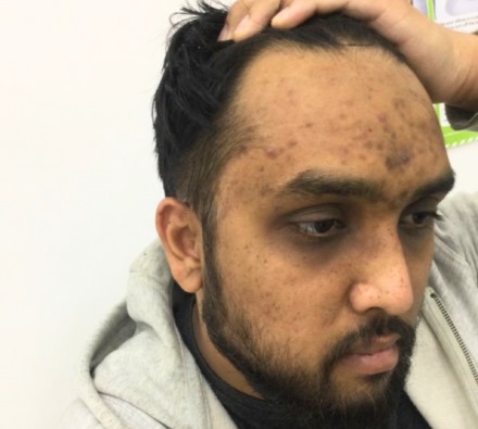 Before and after Obagi Nu-Derm skin transformation