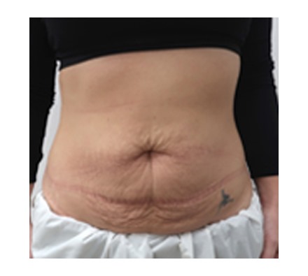 Mummy tummy makeover