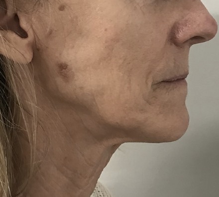 Lower Face Morpheus 8 Before and After, *Individual results may vary