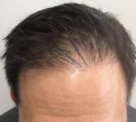 PRP Hair Loss Treatment Before and After