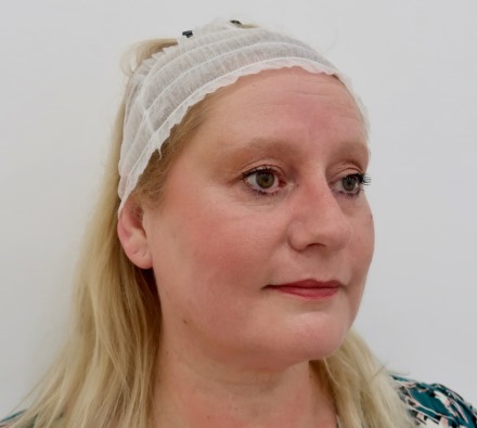 Before and After Silhouette Soft Thread Lift ( 2 weeks apart)