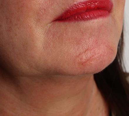 Before and after one vascular laser session