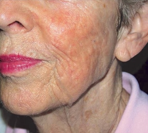 Facial redness before and after laser treatment