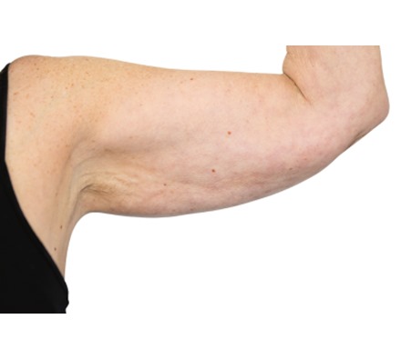 Lanluma V Arm Before & After 