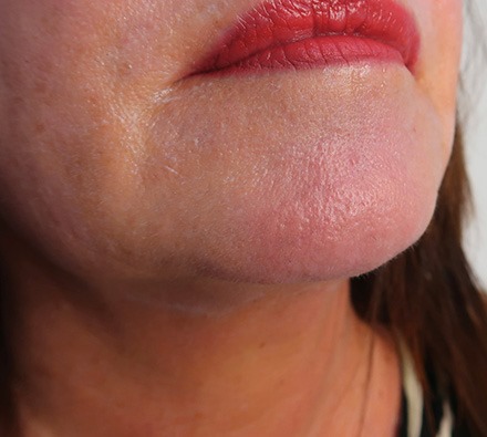 Before and after one vascular laser session