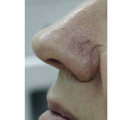 BEFORE AND AFTER VASCULAR LASER