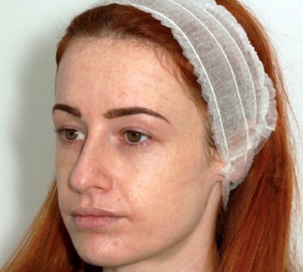 Fox eye lift before and after 