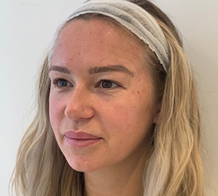 Fox eye lift before and after 