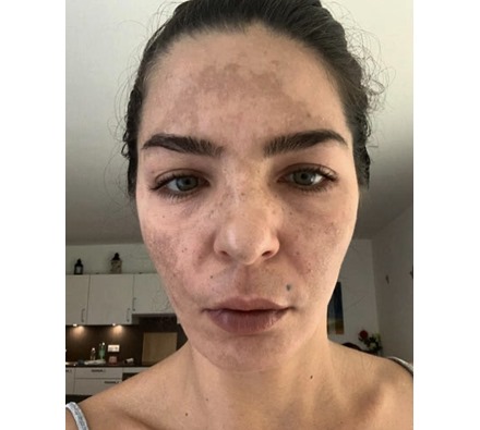Obagi Nu-Derm before and after by Dr Leah Clinic