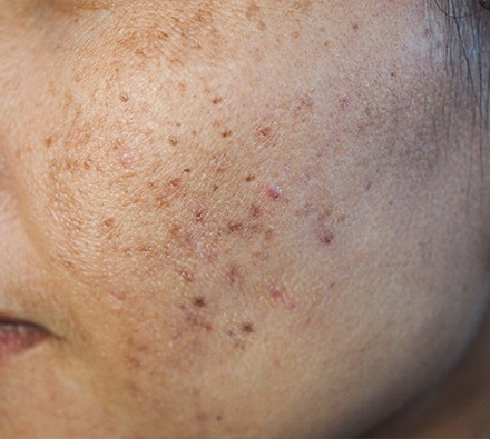 Before and after course of 6 Dermapen treatments with Uber peel