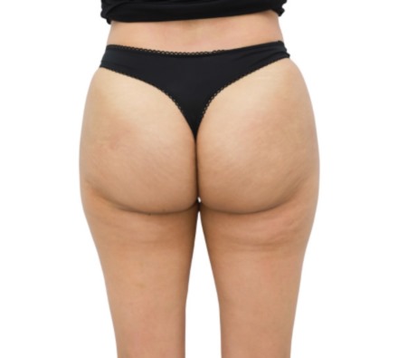 Lanluma Bum Lift Before and After 