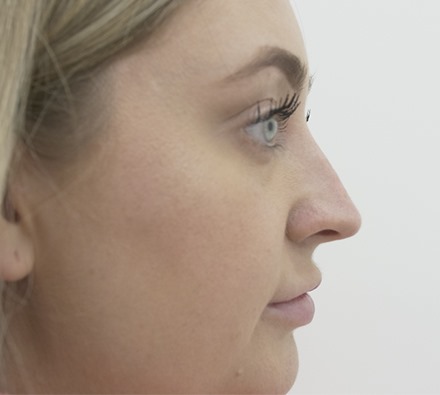 Before and After Non-surgical Rhinoplasty 