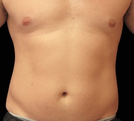 Male abdomen before and after EmSculpt Neo. Photos courtesy of Richard Goldfarb, M.D.
