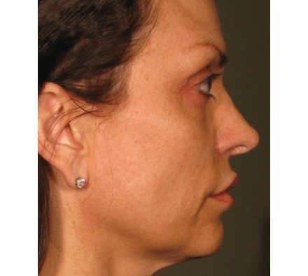 Ultherapy Full Face Before and After, *Individual results may vary