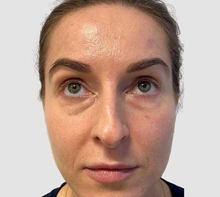 Under eye tear trough filler before and after