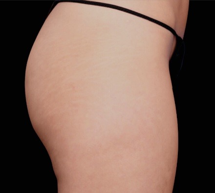 Buttocks before and after EmSculpt Neo. Photos courtesy of Lasky Aesthetics.