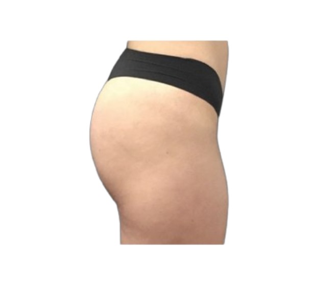 Dr Leah Clinics EmSculpt Neo non-surgical bum lift before and after