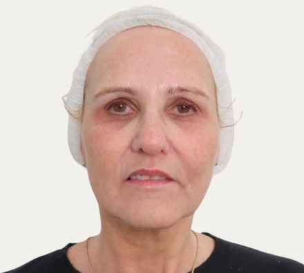 Before and after Morpheus8 and exosomes. Individual results may vary.