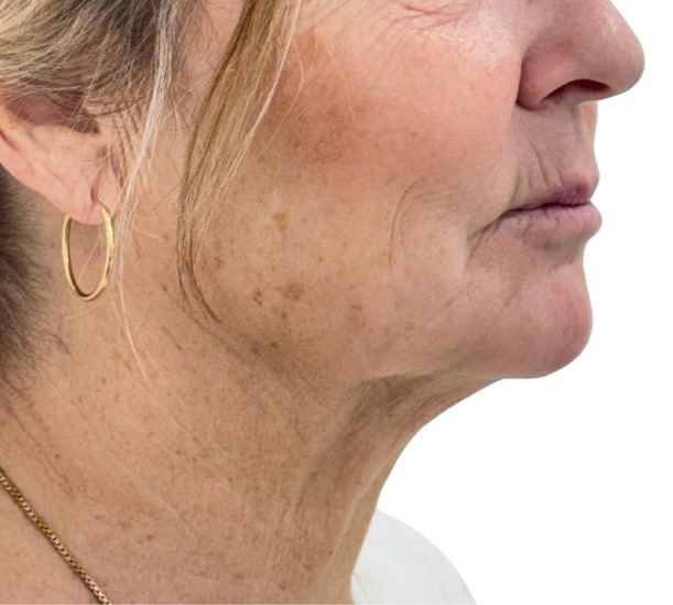 Quantum RF before and 10 weeks after treatment