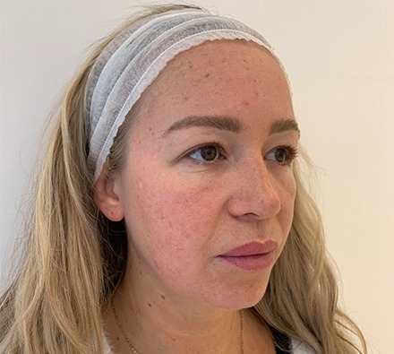 Fox eye lift before and after 