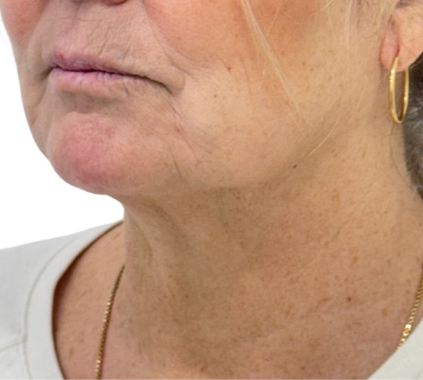 Quantum RF before and 10 weeks after treatment