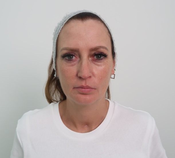Polynucleotide full face before and after