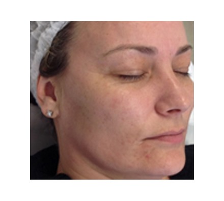 Pigmentation removal laser (sun spot removal)