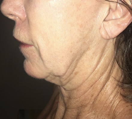 Neck Morpeheus 8 Before and After, *Individual results may vary