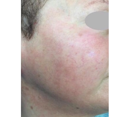 Rosacea before and after vascular laser treatment