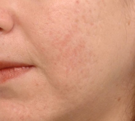 i-pixel harmony laser to treat acne scarring 