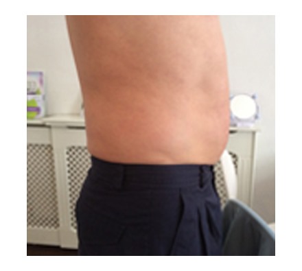 Fat dissolving injection