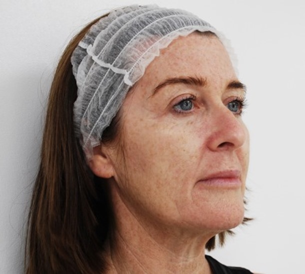 Before and after Profhilo treatment