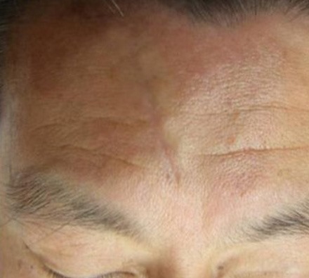 i-pixel harmony laser to treat facial scar 